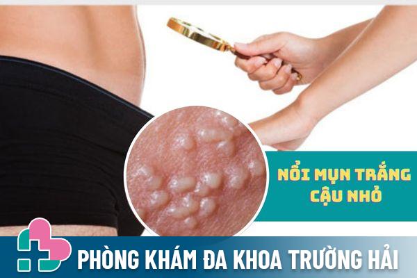 Nổi mụn trắng cậu nhỏ là biểu hiện của bệnh gì?