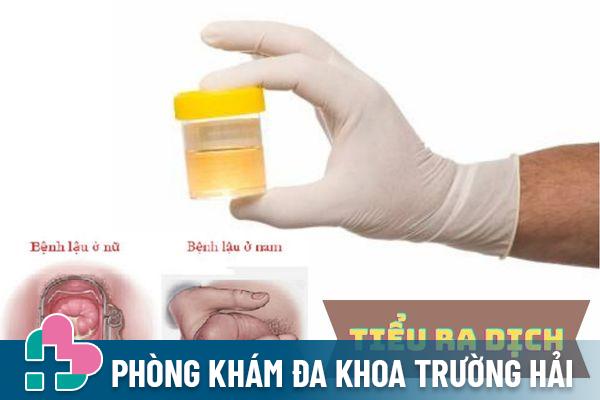 Tiểu ra dịch mủ – Dấu hiệu cảnh báo bệnh lậu không nên bỏ qua