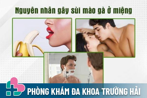 Sùi mào gà ở miệng lây qua nhiều đường khác nhau