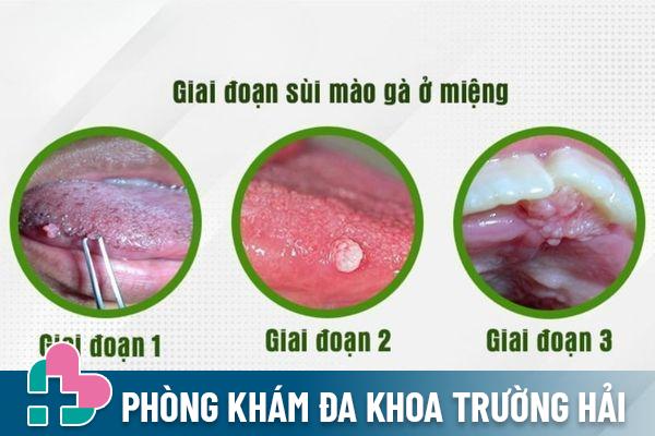 Các triệu chứng nhận biết sùi mào gà ở miệng