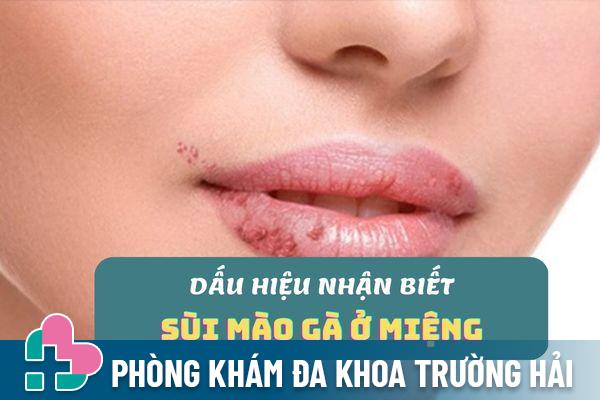 Dấu hiệu nhận biết sùi mào gà ở miệng cần lưu ý kỹ