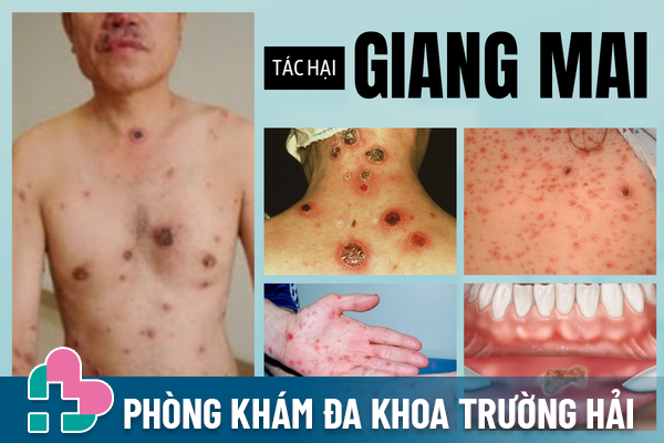 Giang-mai-khong-chi-dai-dang-ma-con-rat-nguy-hiem-3