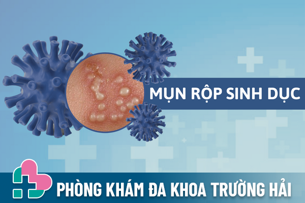 Mụn rộp sinh dục – Tưởng mụn mủ đơn giản nhưng lại cực nguy hiểm.