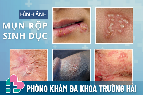 Mun-rop-sinh-duc-tuong-mun-mu-don-gian-nhung-lai-cuc-nguy-hiem-2