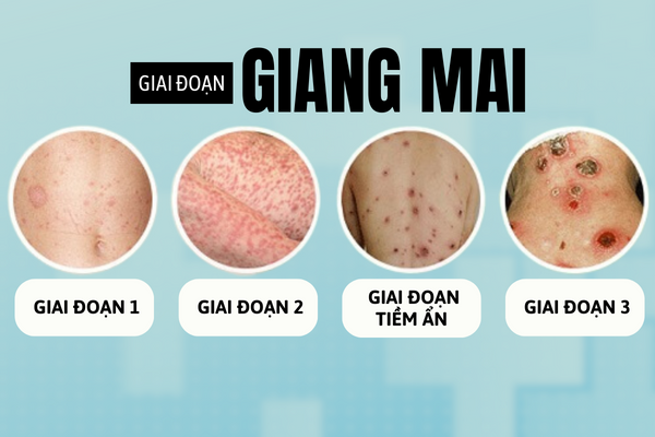 Giang-mai-khong-chi-dai-dang-ma-con-rat-nguy-hiem-can-phat-hien-som