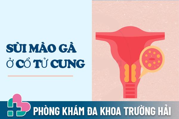 Sùi mào gà ở cổ tử cung – Tác hại nguy hiểm và cách chữa trị