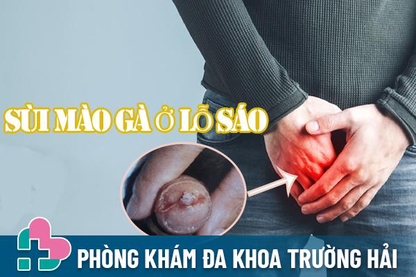 Sùi mào gà ở lỗ sáo: Dấu hiệu, tác hại và cách điều trị