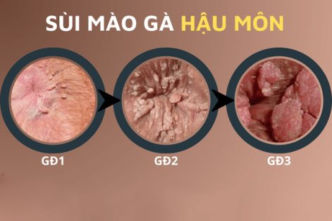 Sùi mào gà hậu môn nguy hiểm khôn lường nhưng ít ai biết