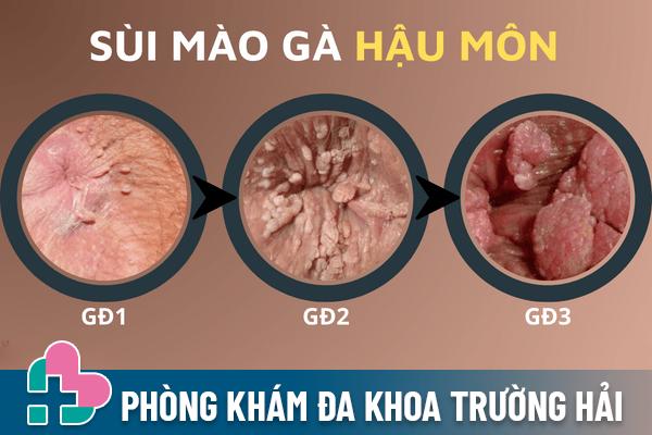 Hình ảnh bệnh sùi mào gà ở hậu môn