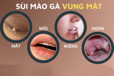 Xác định hình ảnh bệnh sùi mào gà ở các vị trí trên cơ thể