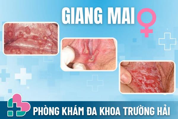 Hinh-anh-giang-mai-giai-doan-dau-2