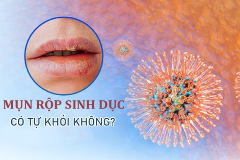 Hỏi đáp: Bệnh mụn rộp sinh dục có tự khỏi?