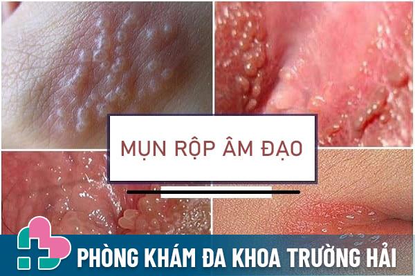 Nhung-dieu-can-biet-ve-mun-rop-am-dao-1