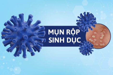 Những điều cần biết về mụn rộp âm đạo