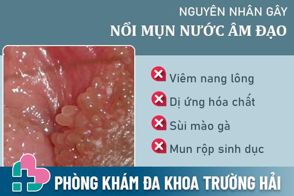 Noi-mun-nuoc-o-am-dao-1