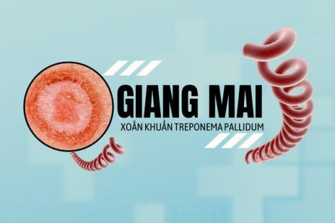 Xác định thời gian ủ bệnh giang mai