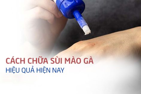 Chữa Sùi Mào Gà Hiệu Quả Chỉ Sau Một Lần Không Lo Tái Phát