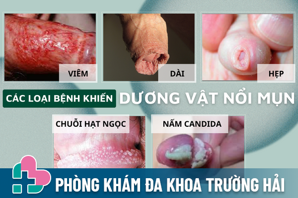 Can-trong-khi-duong-vat-noi-mun-1