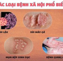 Xét Nghiệm Mụn Rộp Sinh Dục - 2