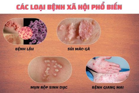 Các dấu hiệu của bệnh xã hội dễ nhận biết