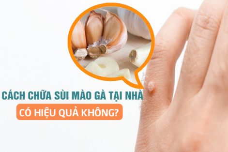 Tìm hiểu về cách chữa sùi mào gà tại nhà