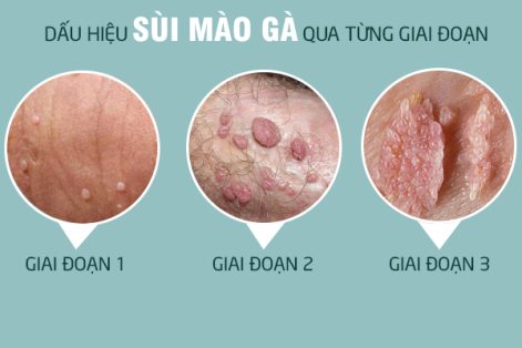 Các giai đoạn của bệnh sùi mào gà: Hình ảnh, Triệu chứng và Cách khắc phục