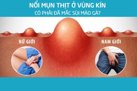 Nổi Mụn Thịt Ở Vùng Kín Nam, Nữ Có Phải Đã Mắc Sùi Mào Gà?