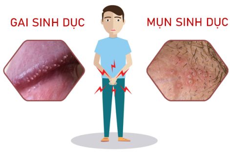 Mụn sinh dục: Dấu hiệu bệnh xã hội chớ chủ quan