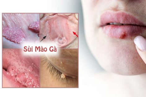 Chi phí điều trị sùi mào gà hiện nay