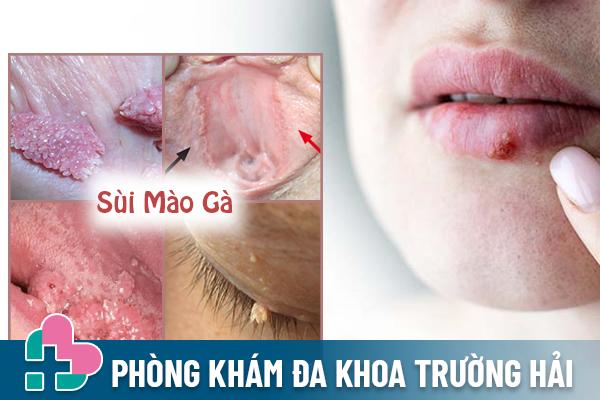 Phuong-phap-ala-ho-tro-dieu-tri-sui-mao-ga-2