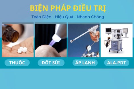 Phương pháp điều trị bệnh sùi mào gà hiệu quả hiện nay