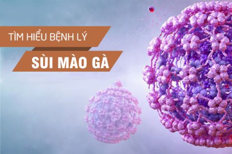 Sùi mào gà: Nguyên nhân, dấu hiệu và biện pháp điều trị