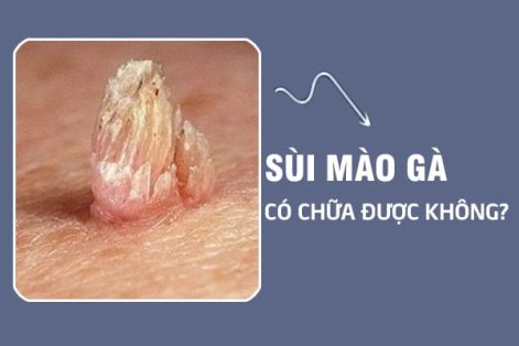 Bệnh Sùi Mào Gà Có Chữa Được Không?