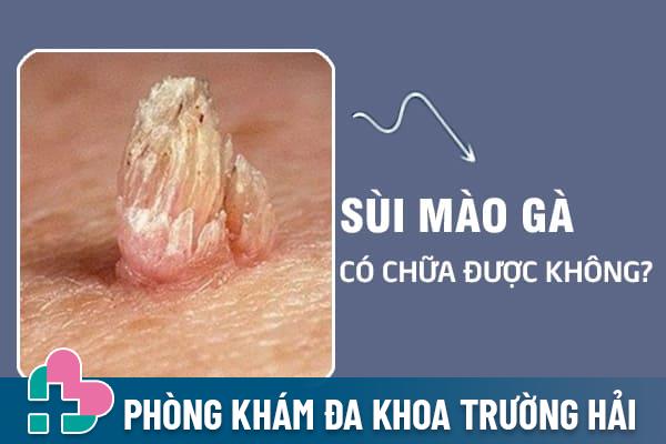 Sui-mao-ga-co-chua-duoc-khong-2