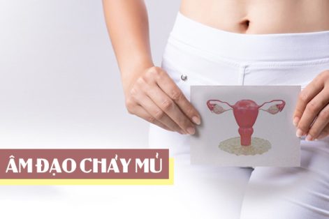 Âm đạo chảy mủ: Nguyên nhân và cách điều trị