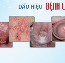 Benh-lau-lay-qua-dau-2