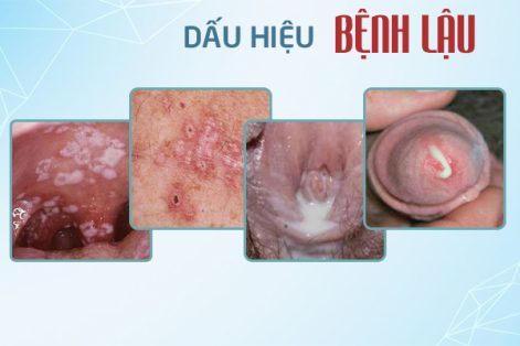 Tiểu buốt có phải mắc bệnh lậu?