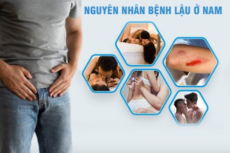 Tìm hiểu nguyên nhân bệnh lậu ở nam và nữ giới