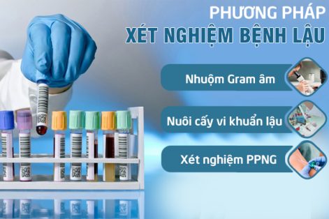 Xét nghiệm bệnh lậu – Cách nhận biết bệnh lậu sớm và chính xác 