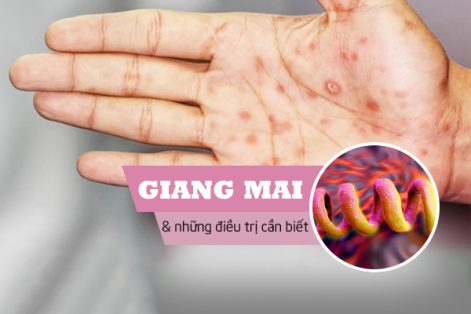 Bệnh giang mai và những thông tin cần biết