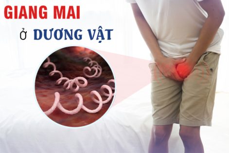 Giang mai ở dương vật: Dấu hiệu và cách điều trị hiệu quả 