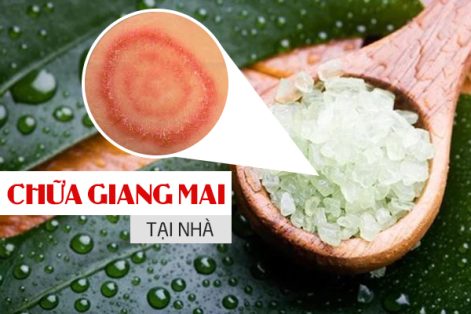 Chữa giang mai tại nhà có an toàn và hiệu quả không?