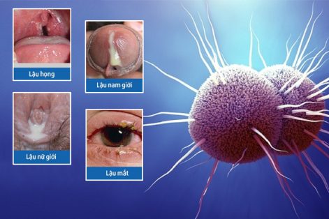 Bệnh lậu: Dấu hiệu, Nguyên nhân và Cách khắc phục hiệu quả