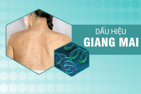 Dấu hiệu & biểu hiện giang mai chớ xem thường 