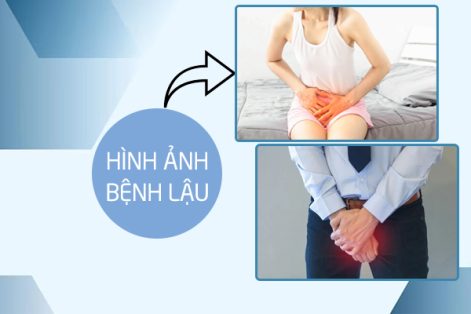 Xem ngay hình ảnh bệnh lậu ở nam và nữ giới