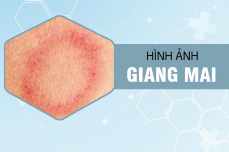 Tổng hợp hình ảnh giang mai qua từng giai đoạn