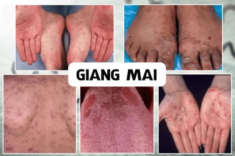 Phương pháp điều trị bệnh giang mai nhanh hết