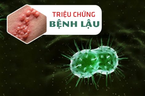 Triệu chứng bệnh lậu là gì? Nhận biết sớm chữa trị kịp thời 