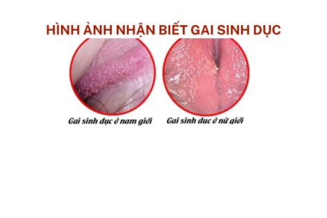 Gai sinh dục là bệnh gì nguy hiểm không?