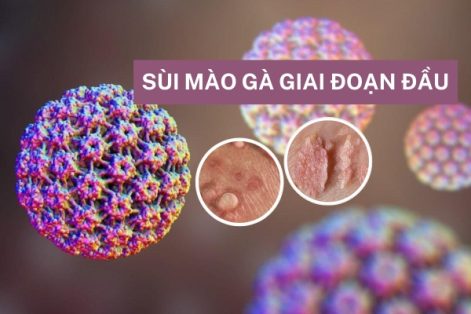 Bệnh sùi mào gà giai đoạn đầu ở nam và nữ